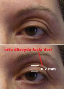 Göz Kapağı Derisi Neden Katlanır? Bilmeniz Gerekenler ve Çözümler - Kapak Görseli