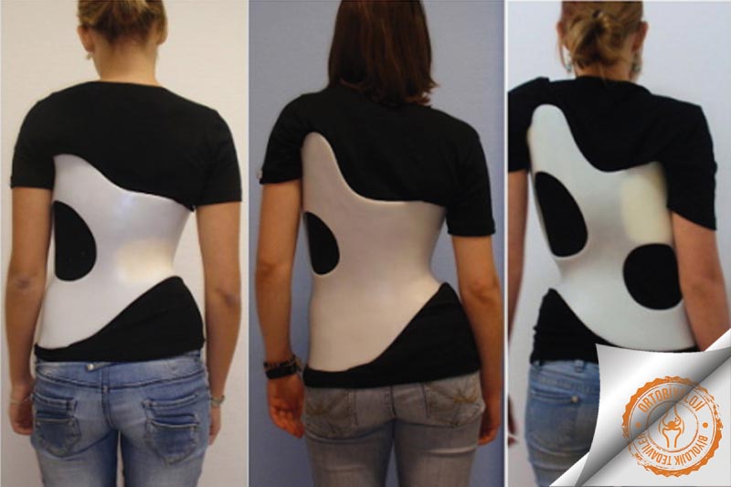 Skolyoz Ortez Çeşitleri Nelerdir? En Etkili Seçenekler ve Kullanım Alanları - Kapak Görseli