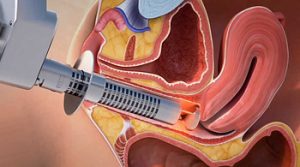 İç Dudak Lazerinin Kalıcılığı ve Uzman Önerileri [2026] - Kapak Görseli