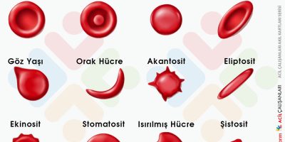 Kalıtsal Sferositozun Riskleri ve Tedavi Yöntemleri [2026 Uzman Rehberi] - Kapak Görseli