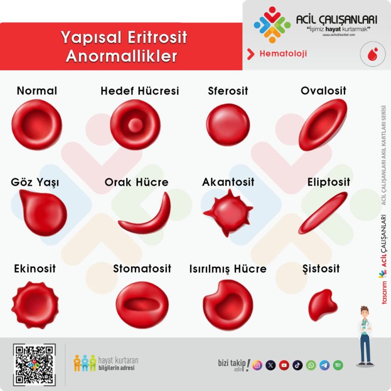Kalıtsal Sferositozun Riskleri ve Tedavi Yöntemleri [2026 Uzman Rehberi] - Kapak Görseli
