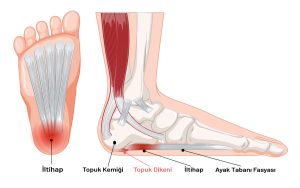Topuk Dikeni Tedavisinde Etkili Fizik Tedavi Cihazları [2026 Rehberi] - Kapak Görseli