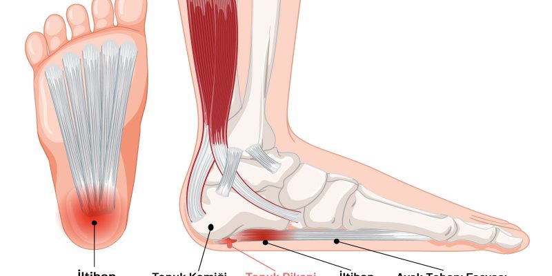 Topuk Dikeni Tedavisinde Etkili Fizik Tedavi Cihazları [2026 Rehberi] - Kapak Görseli
